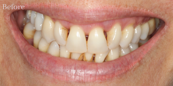 راه های پیشگیری پوسیدگی دندان