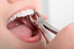 بیهوشی عمومی برای دندانپزشکی