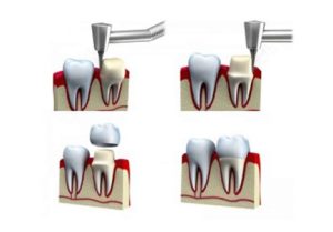 انواع روکش دندانی