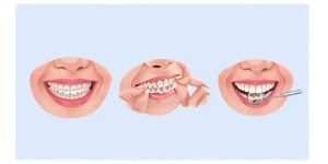 آشنایی با انواع روش های زیبایی دندان